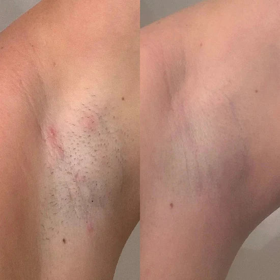 Luvixiaglow — Sérum naturel qui ralentit la repousse des poils