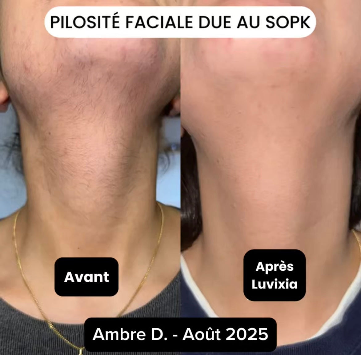 Luvixiaglow — Sérum naturel qui ralentit la repousse des poils